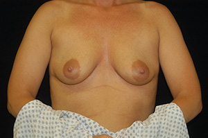 Breast Augmentation 10a